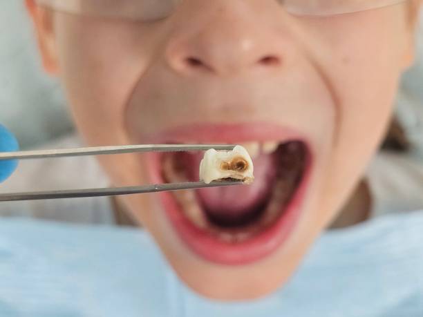 Best Knocked-Out Tooth (Avulsed Tooth) Treatment in , MO